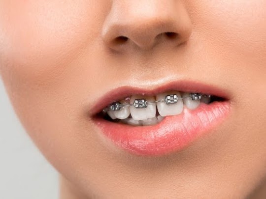 Afte in bocca causate da apparecchio, come prevenirle?
