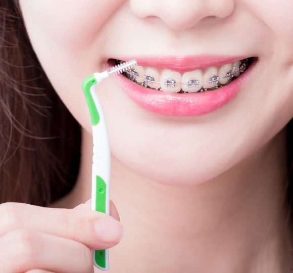 Una corretta pulizia dentale con l’apparecchio fisso
