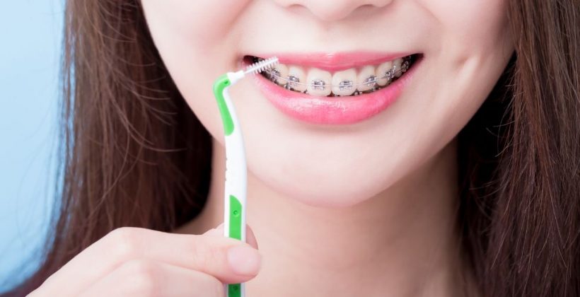 Una corretta pulizia dentale con l’apparecchio fisso