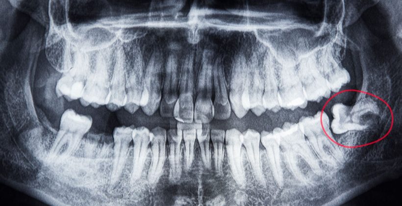 Denti del giudizio: quando è necessario toglierli?