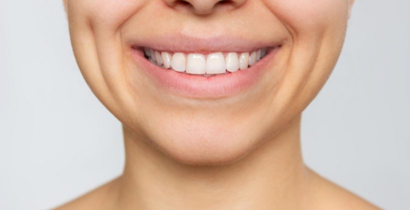 Una bocca perfetta con le faccette dentali!