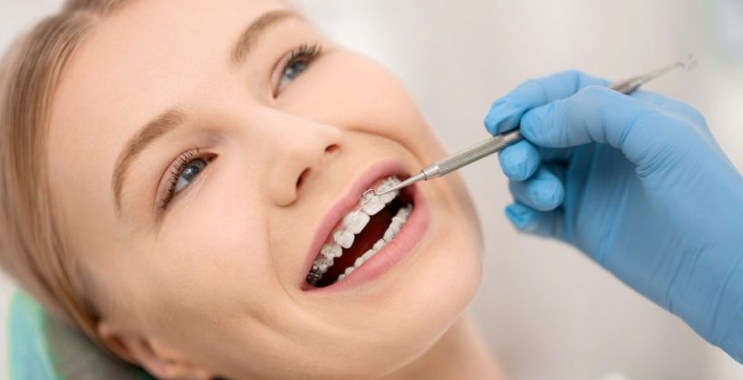 Ortodonzia fissa: i benefici dell’apparecchio fisso