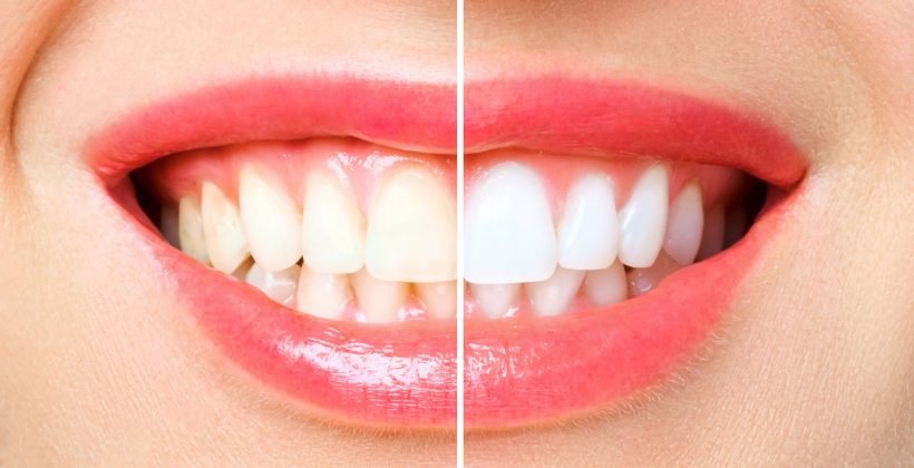 Sbiancamento denti: il sorriso torna a risplendere