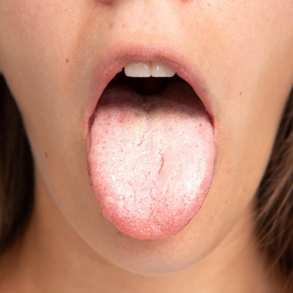 patina bianca piercing lingua