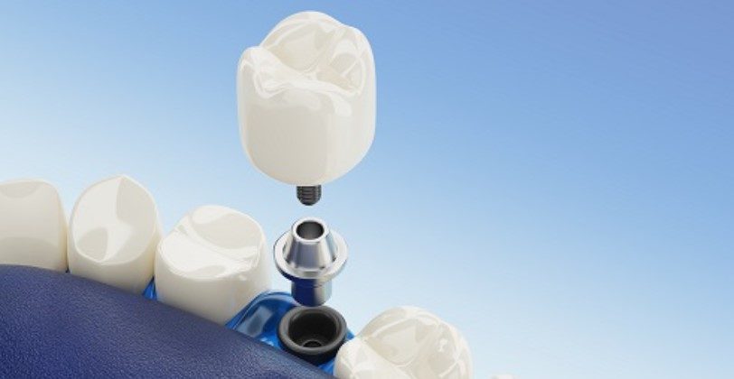 Corona dentale: che cos’è, quali sono i materiali di cui è fatta e quali tipologie esistono?