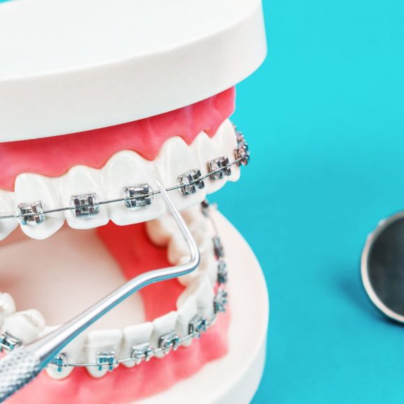 Quanto tempo occorre per allineare i denti con l’apparecchio ortodontico?