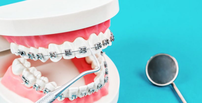 Quanto tempo occorre per allineare i denti con l’apparecchio ortodontico?