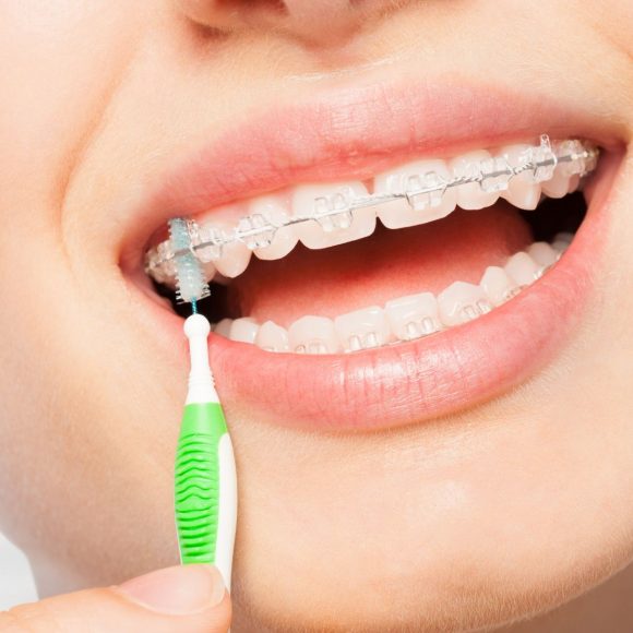 Come scegliere il giusto scovolino per l’apparecchio fisso