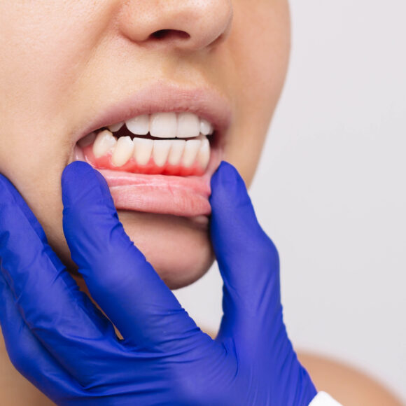 Salvare il dente dalla parodontite apicale acuta: diagnosi precoce e trattamenti efficaci
