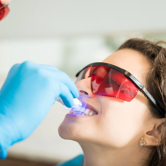 Sbiancamento dei Denti: Metodi, Sicurezza e Considerazioni