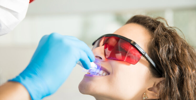 Sbiancamento dei Denti: Metodi, Sicurezza e Considerazioni Sbiancamento dei Denti: Metodi, Sicurezza e Considerazioni