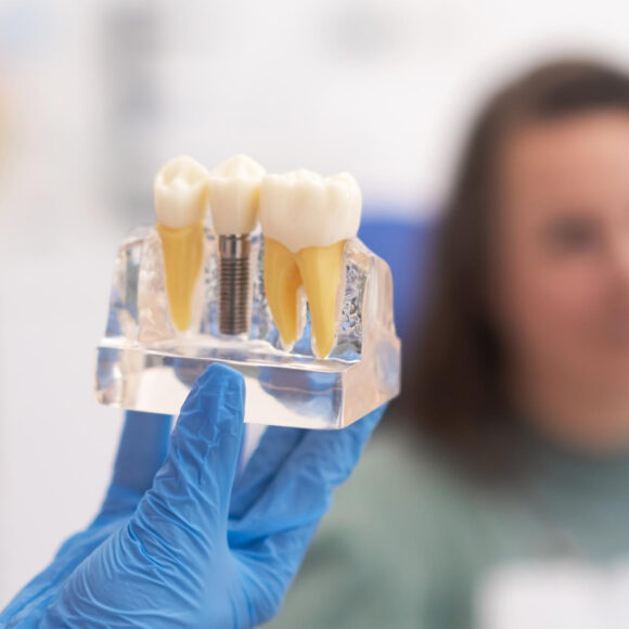 Implantologia: miti da sfatare e realtà da conoscere