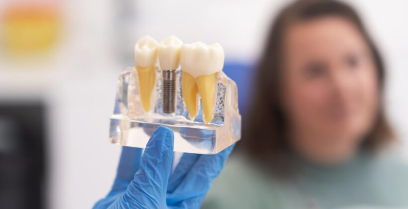 Implantologia: miti da sfatare e realtà da conoscere