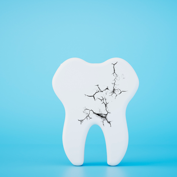 Dente rotto o scheggiato: cosa fare nell’immediato