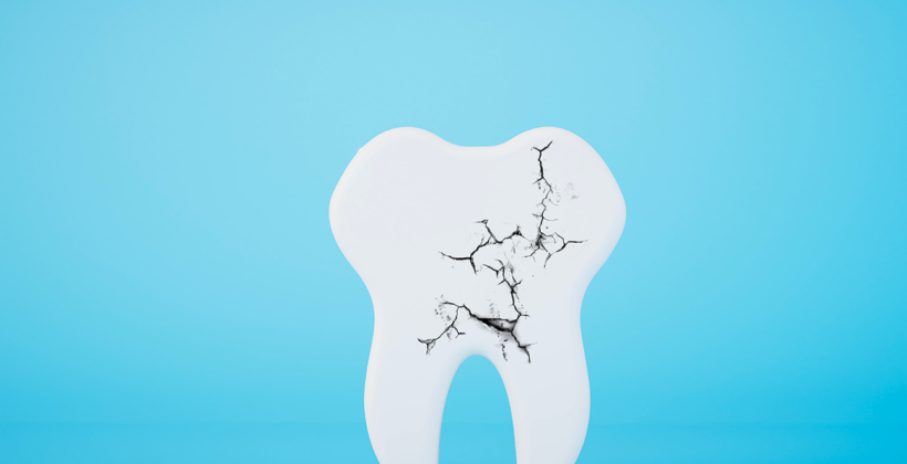 Dente rotto o scheggiato: cosa fare nell’immediato