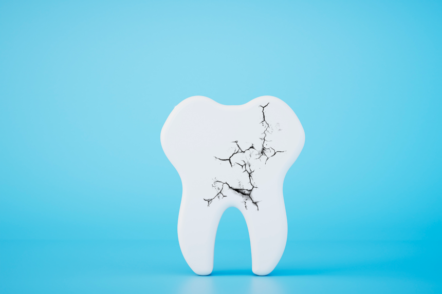 Dente rotto o scheggiato: cosa fare nell’immediato Dente rotto o scheggiato: cosa fare nell’immediato