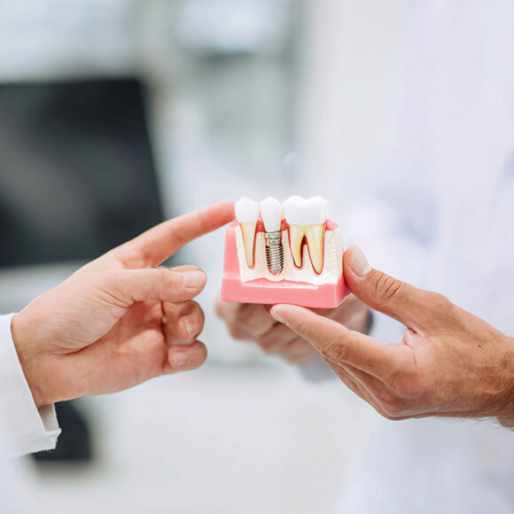 Impianto dentale o ponte: quale soluzione scegliere?