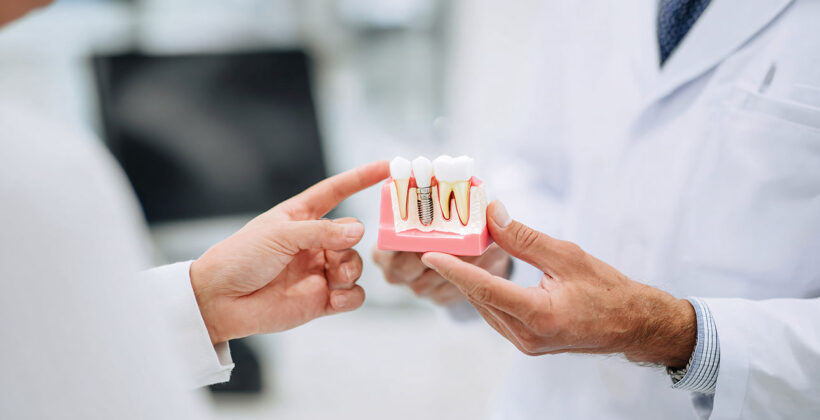 Impianto dentale o ponte: quale soluzione scegliere?